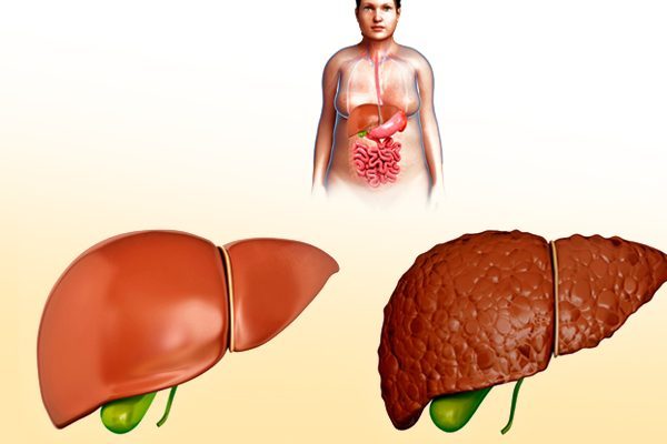 Fatty Liver