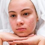 Home remedies for acne