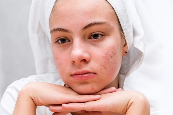 Home remedies for acne