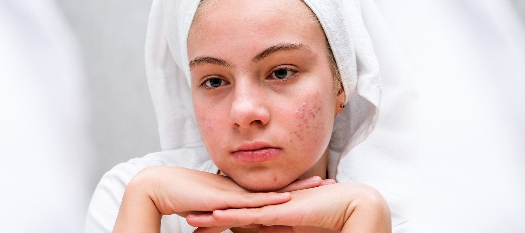 Home remedies for acne