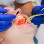 Wisdom teeth removal